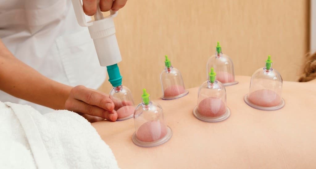 Practitioner applying suction cupping therapy to the upper back